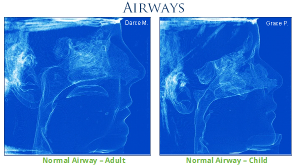 Normal airways.jpg